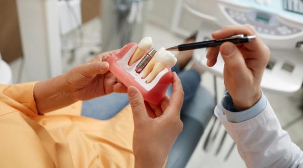 De ce să alegi implantul dentar Straumann pentru un rezultat pe termen lung