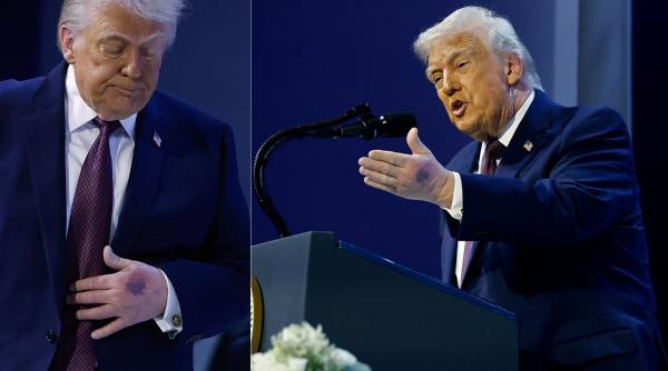 Mulți au observat că Donald Trump avea o mână învinețită la Forumul de la Davos. Ce explicație a dat președintele SUA