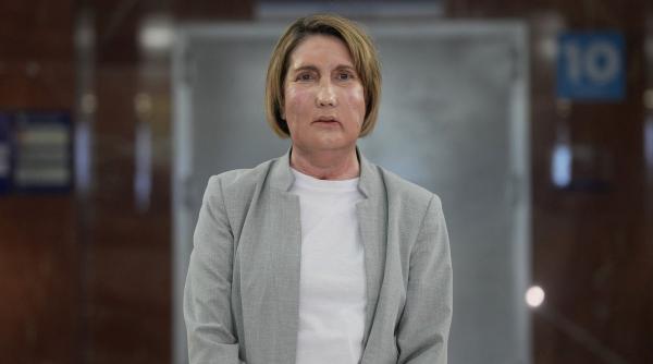 primul transplant de fata din lume cu donator decedat prin eutanasie a fost realizat la un spital din barcelona