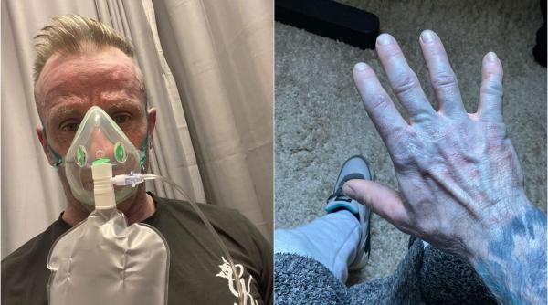 Un bărbat s-a dus la Urgențe cu pielea albastră. Panicați, medicii i-au pus masca de oxigen, apoi și-au dat seama ce avea, de fapt