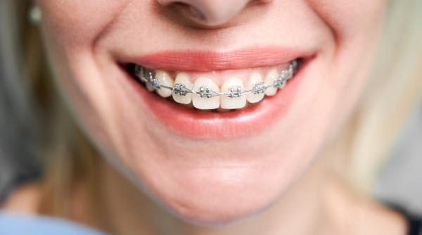 de ce tot mai multi adulti aleg aparatul dentar si ce a schimbat ortodontia moderna