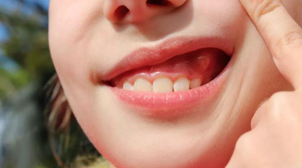 5 semne că ar trebui să mergi la dentist mai repede decât crezi