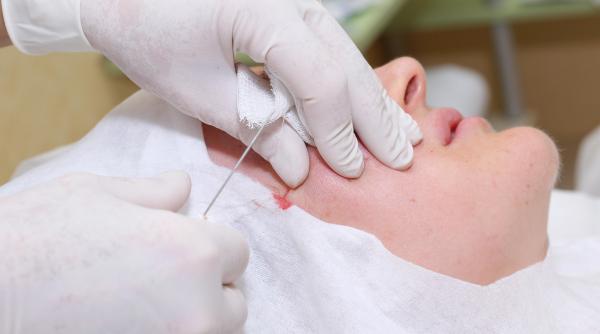 reactia societatii de chirurgie estetica dupa ce o femeie a murit in urma unui mini lifting facial