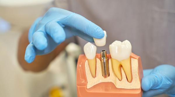 cat costa un implant dentar premium in 2026 si ce include pretul