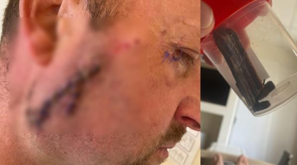caz revoltator la spitalul din satu mare un barbat a ramas cu bucati de lemn in fata dupa ce a fost cusut de un ginecolog