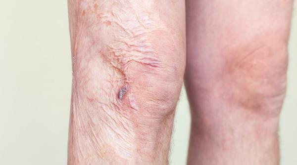 cicatricile post arsura tratamente si interventii reconstructive suportate de cas