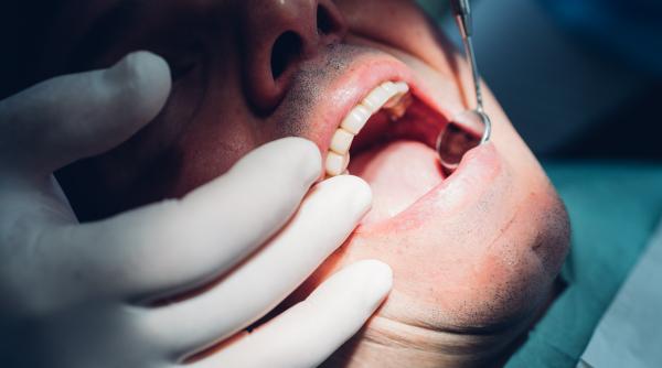 dinti ficsi in 24 de ore mit sau realitate ce spun medicii despre implanturi tehnologia digitala si durata de viata a danturii fixe