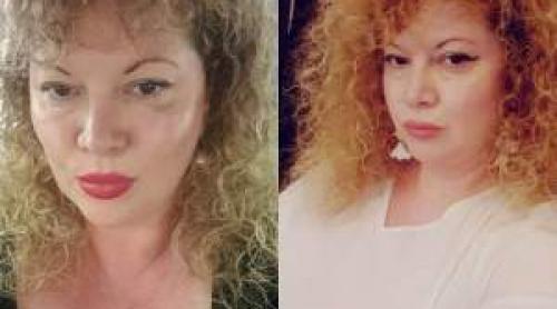 Semnul pe care Oana Lis l a primit după ce s a accidentat. Blondina a povestit prin ce trece