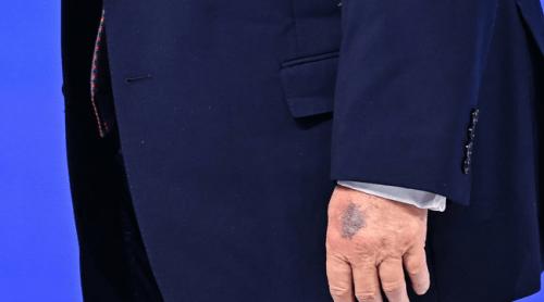 Starea de sănătate a lui Trump, din nou în atenția publică: vânătăi, umflături sub sacou și poticneli în vorbire. Reacția Casei Albe