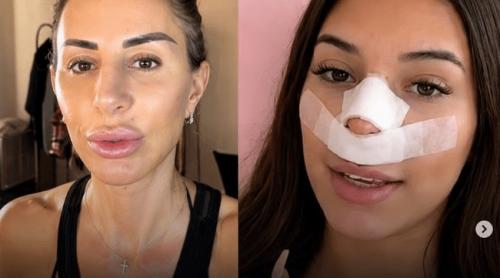 Influencerița care și a făcut rinoplastie pentru ca viitorii săi copii „să nu îi moștenească nasul”. Ideea a primit replici pe măsură: „La o operație pe creier te ai gândit?”