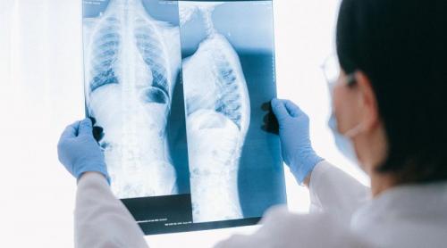 Rata de supraviețuire și speranța de viață după transplantul pulmonar