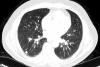 Testul care demonstrează că radiologii pot omite detalii vitale. Tu vezi gorila din imagine? 193004