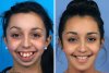 Nu ii mai crescuse obrazul de la varsta de opt ani, iar dintii ii avea deformati - Dupa patru ani de operatii, tanara s-a transformat complet! 400096