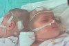 Două gemene unite la ceafă au fost separate chirurgical printr-o operație extrem de rară, în Israel 725550