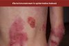 Afecțiunile dermatologice la copii și terapia adjuvantă cu imunoglobuline Y Imunoinstant  748942