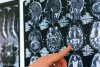 Asta îți macină creierul. Prof. dr. Vlad Ciurea: ”Celulele nervoase scad”. Cum ajuți creierul să funcționeze mai bine 776864